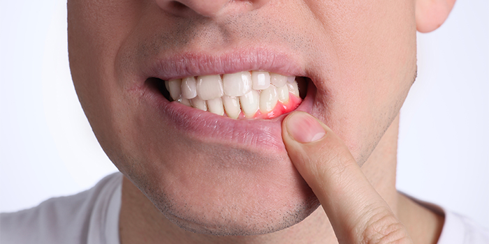 Swollen Gums: Causes, Treatment & Prevention